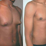 Como Eliminar los Senos Masculinos Sin Cirugia